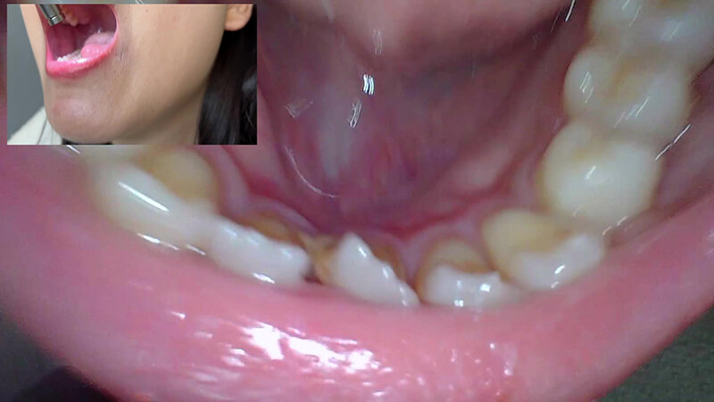 【素人】【特価】口腔観察VOL.2 4名55分お買い得セット│口内クイーン│h_1651nko00005