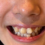 【素人】街角で声をかけて口内観察させてもらう カフェ店員 ひなちゃん│口内クイーン│h_1651nko00021