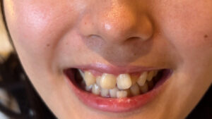 【素人】街角で声をかけて口内観察させてもらう カフェ店員 ひなちゃん│口内クイーン│h_1651nko00021