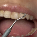 【素人】【歯・口内フェチ】「素人人妻マナミさんの超貴重な歯＆口内観察！」マナミ│アドア│h_1416ad01840