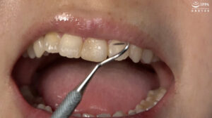 【素人】【歯・口内フェチ】「素人人妻マナミさんの超貴重な歯＆口内観察！」マナミ│アドア│h_1416ad01840