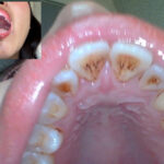 【素人】街角で声をかけて口内観察させてもらう コールセンターアルバイト あむちゃん│口内クイーン│h_1651nko0500002