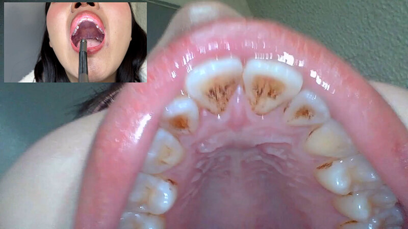 【素人】街角で声をかけて口内観察させてもらう コールセンターアルバイト あむちゃん│口内クイーン│h_1651nko0500002